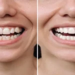 Dental Crowns Before and After