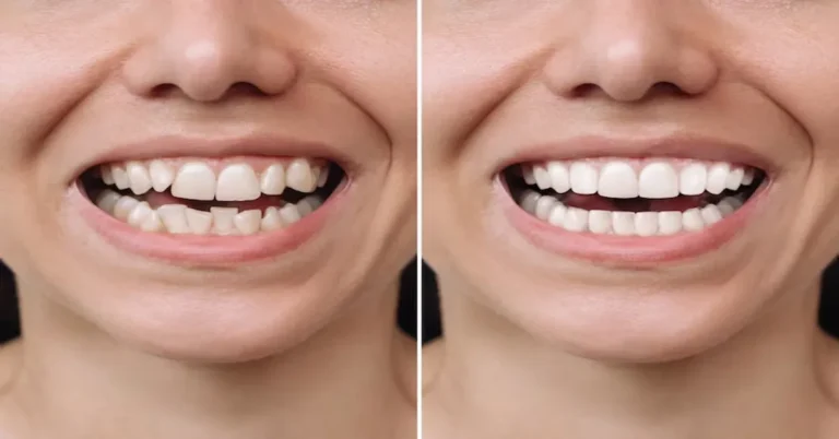 Dental Crowns Before and After