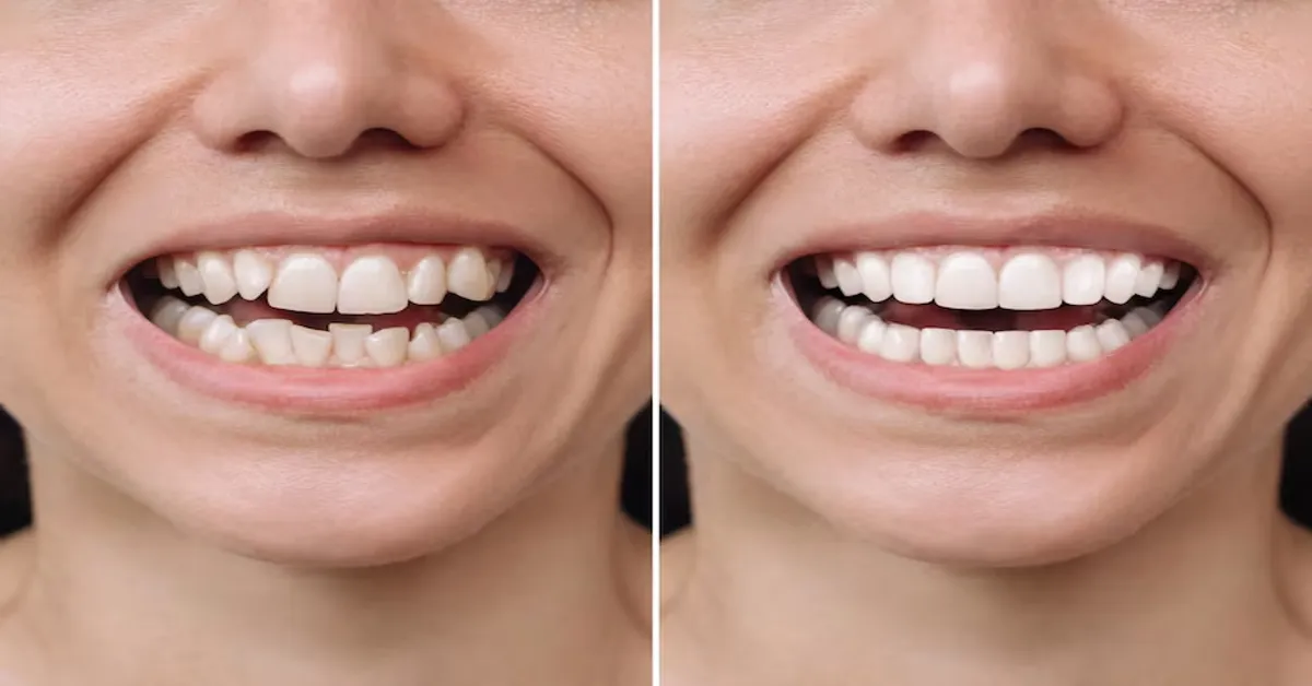 Dental Crowns Before and After