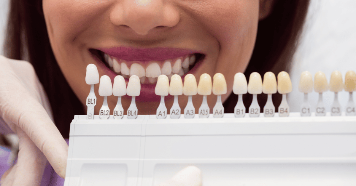 dental veneers for missing teeth