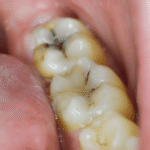 small cavity