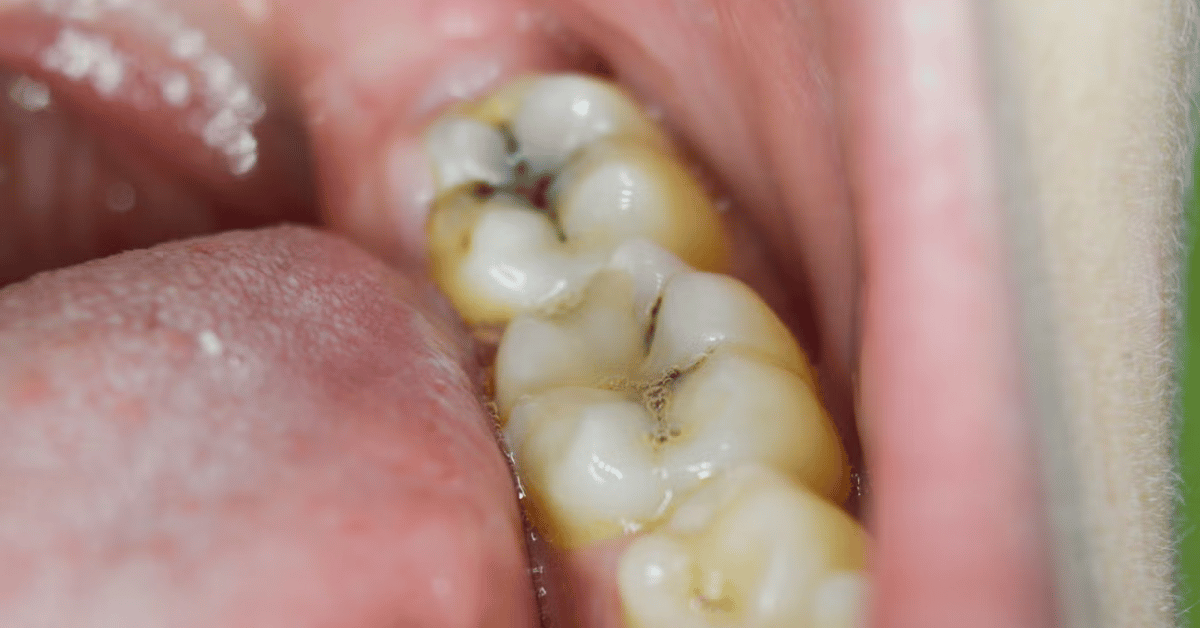 small cavity