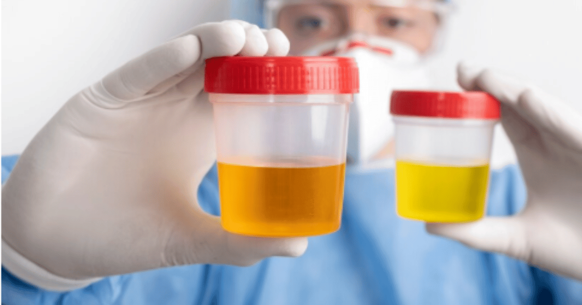weak urine stream