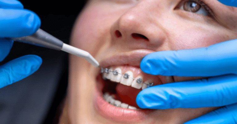 ceramic braces