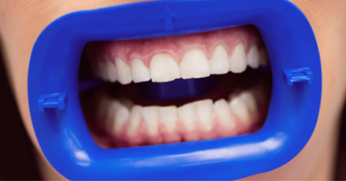 front tooth crown
