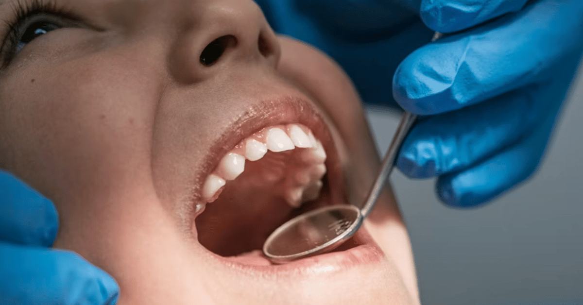 teeth bonding
