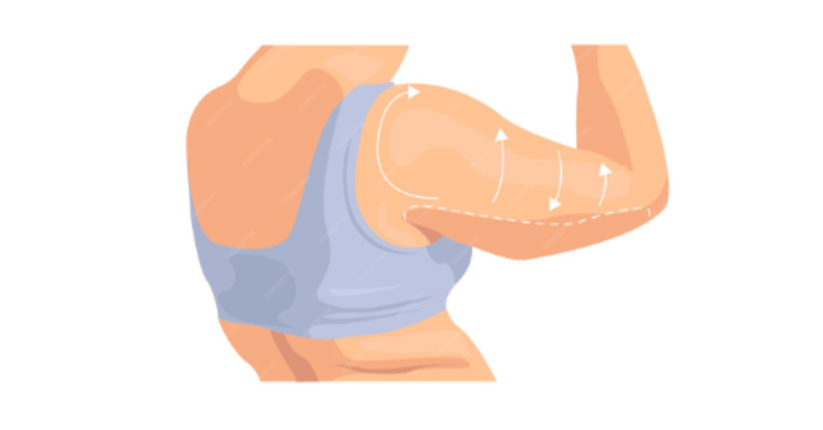 brachioplasty